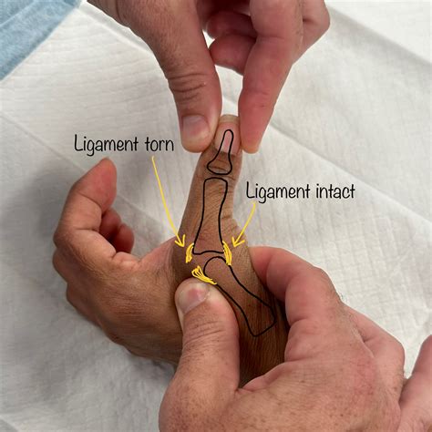 torn thumb ligament test